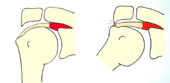 « Bec » acromial entraînant le conflit - 4.0&nbsp;Ko