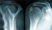 Information sur l'intervention d’évacuation des Calcifications d’épaule - 4.4&nbsp;Ko