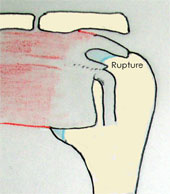 Information sur l'intervention de réparation arthroscopique de la rupture de la coiffe des rotateurs - 8.6&nbsp;Ko