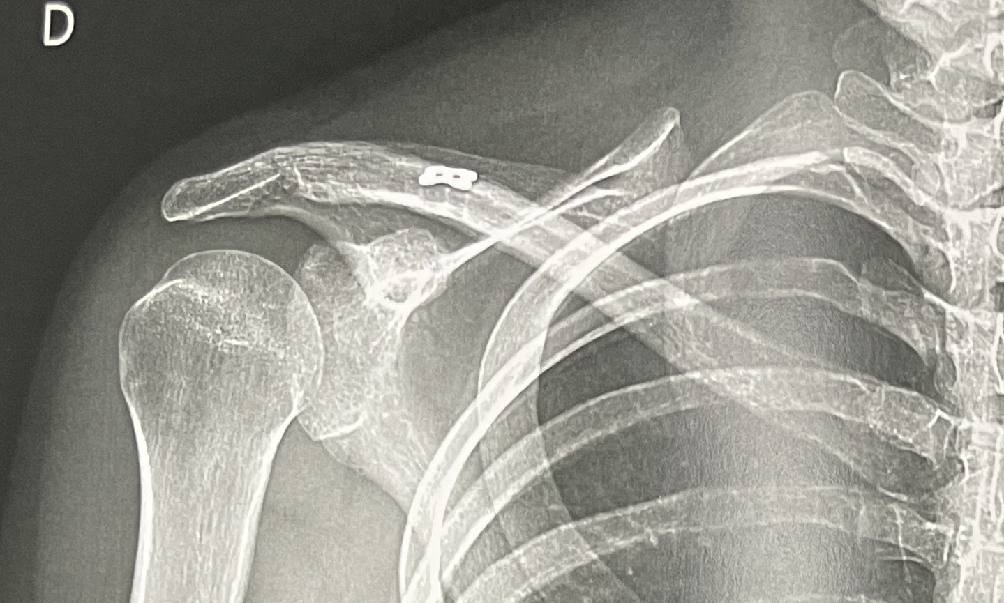 Fracture quart externe clavicule Neer 2B
