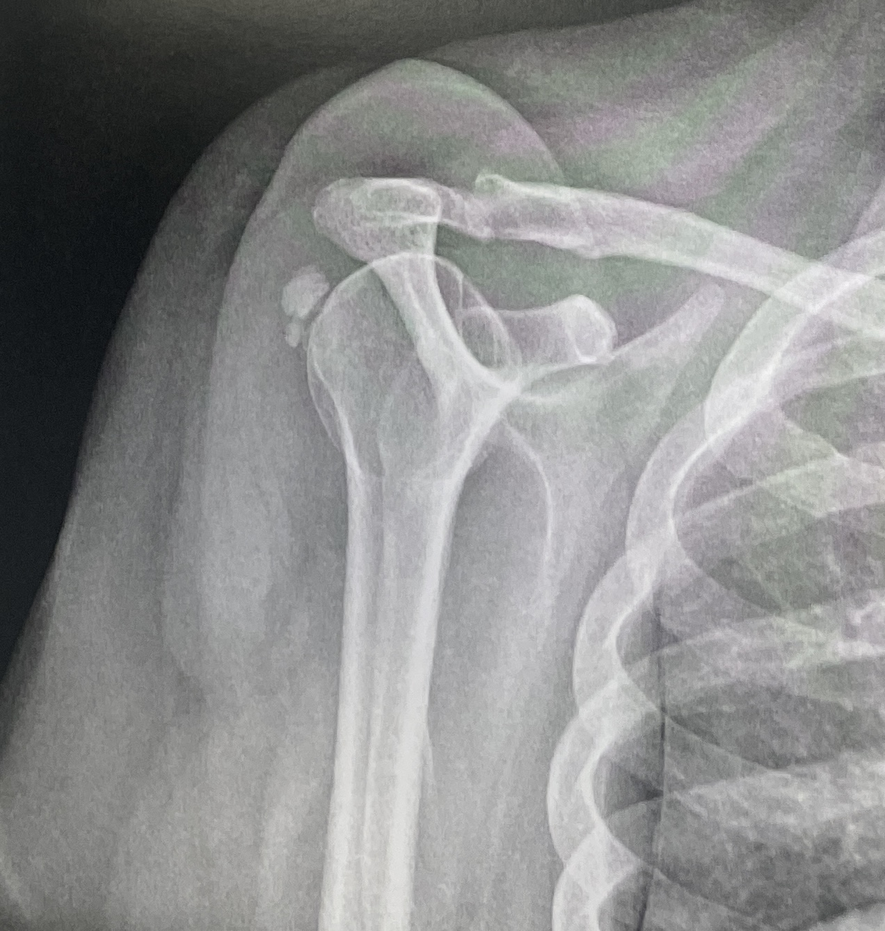 Tendinopathie Calcifiante infra &eacute;pineux Dr Gravier