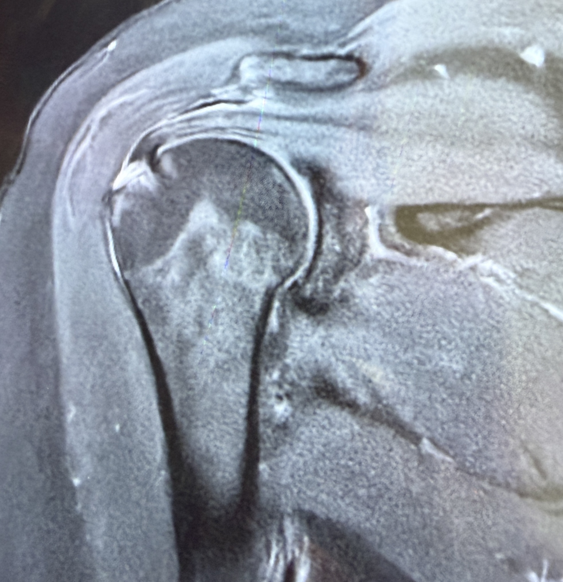 Rupture de La coiffe des rotateurs Dr GALLAND