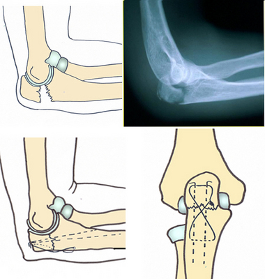 Les fractures du coude